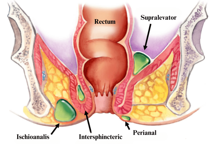 anal abscess location