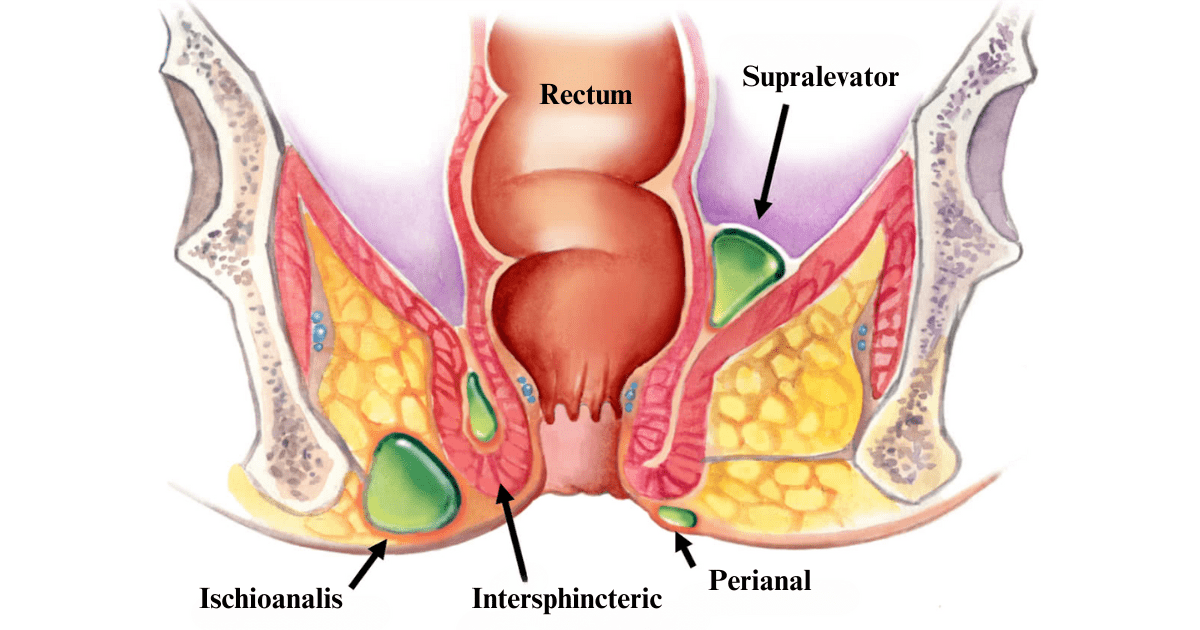 Anal Abscess: Symptoms, Causes, and Effective Treatments