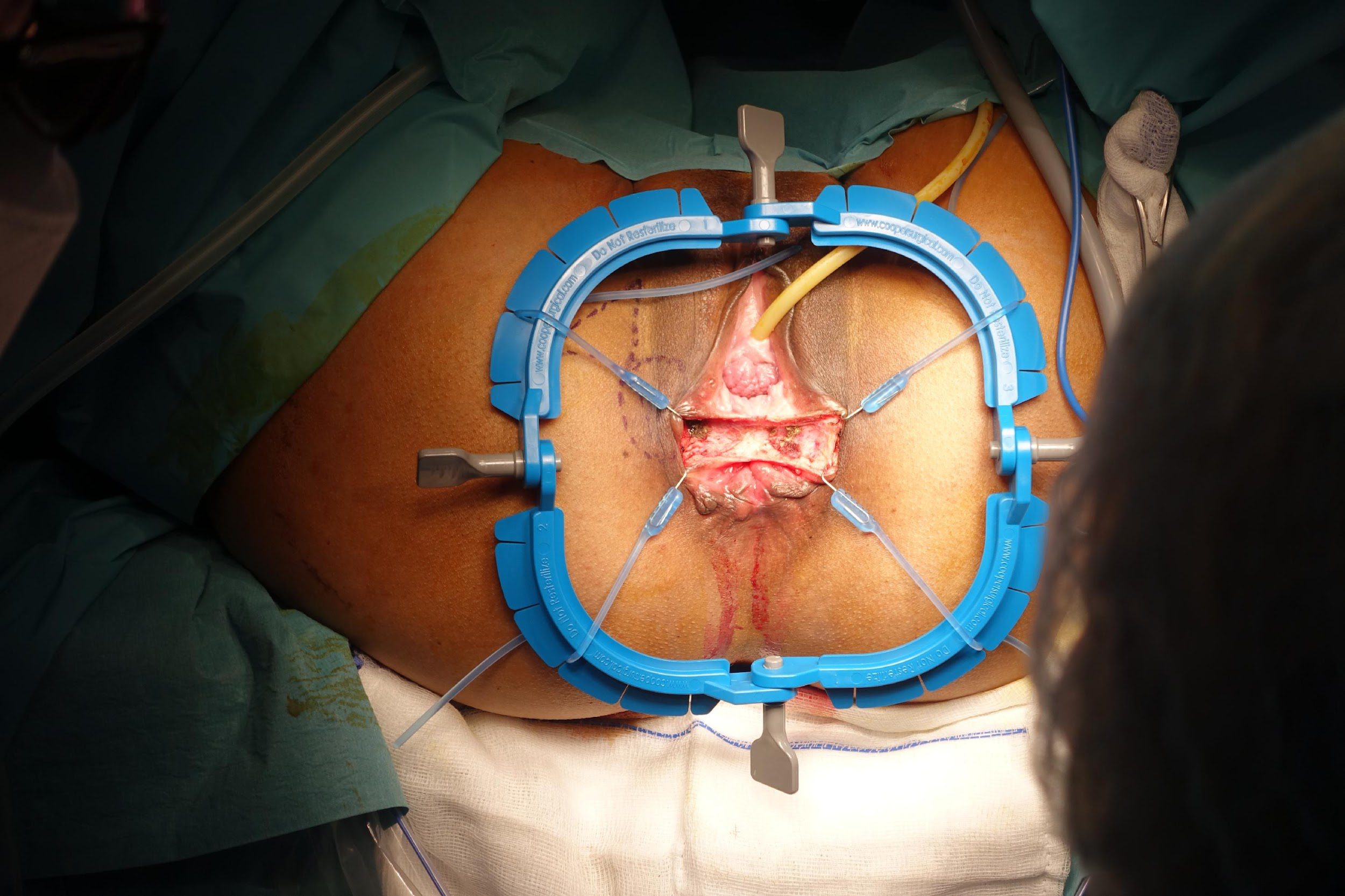 Surgery