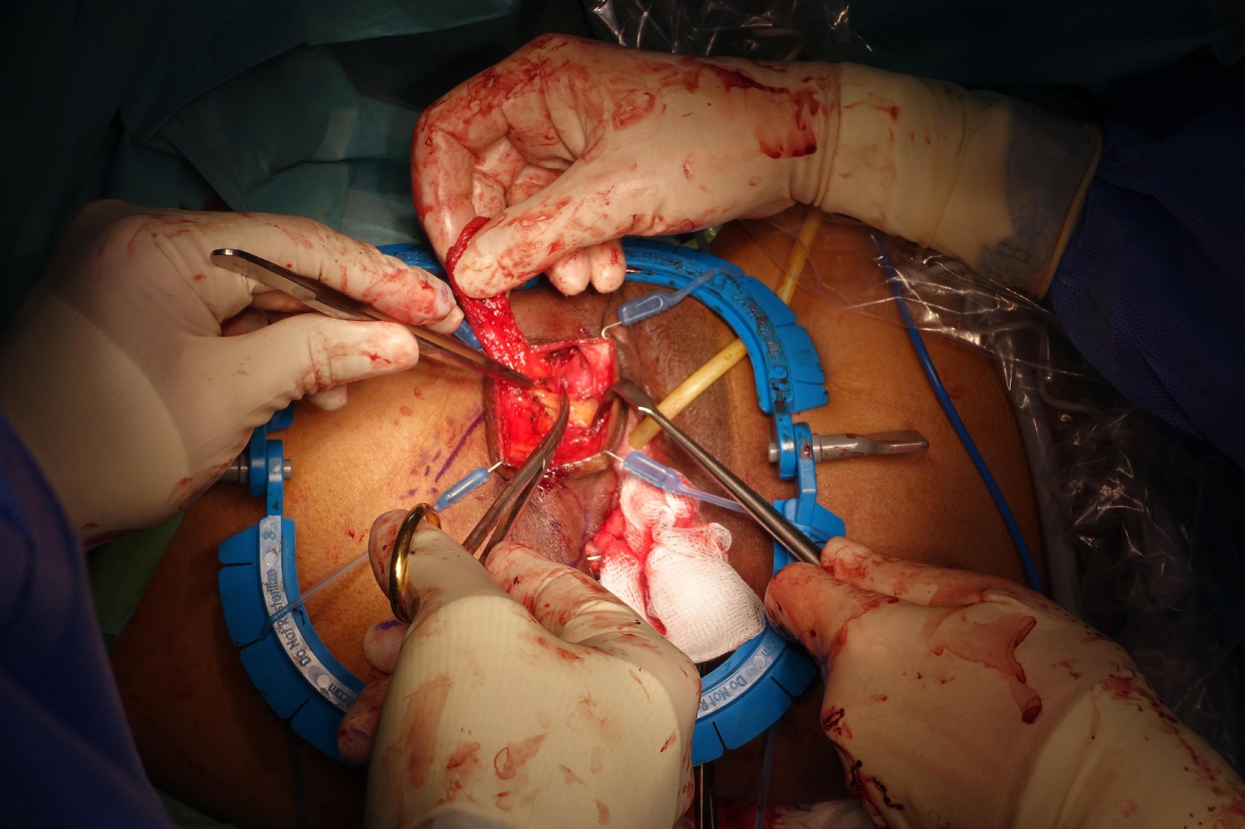 Surgery