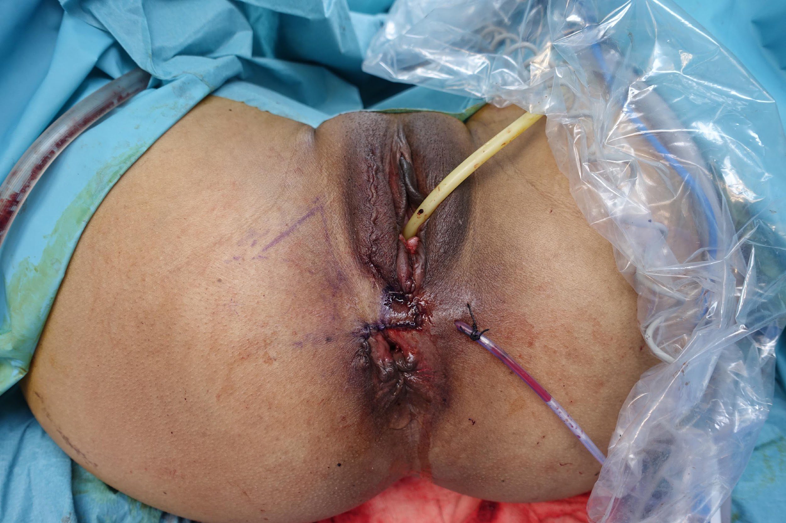 Surgery