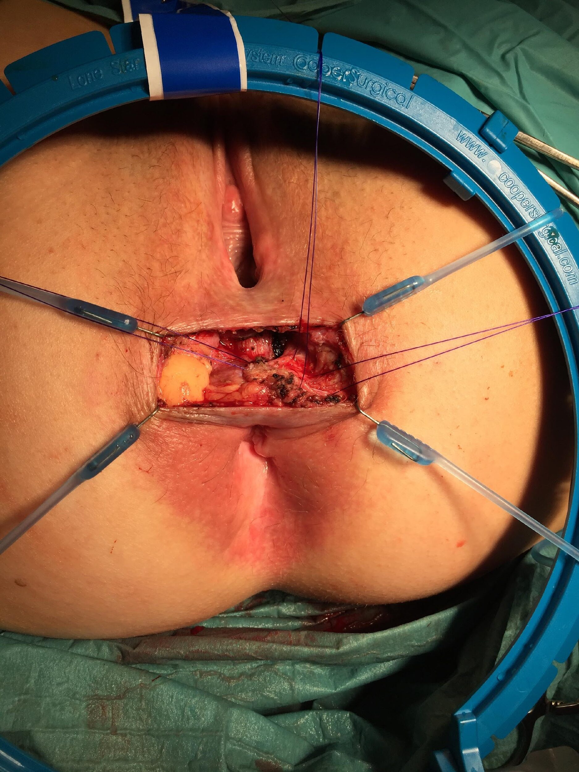 Surgery