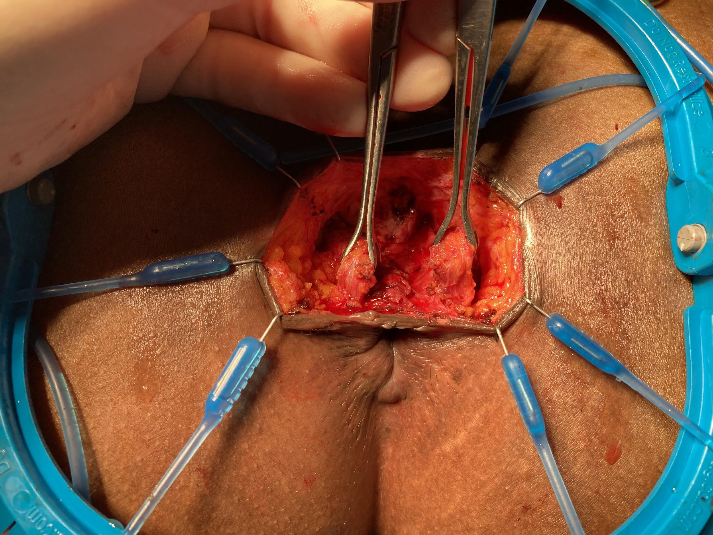 Surgery