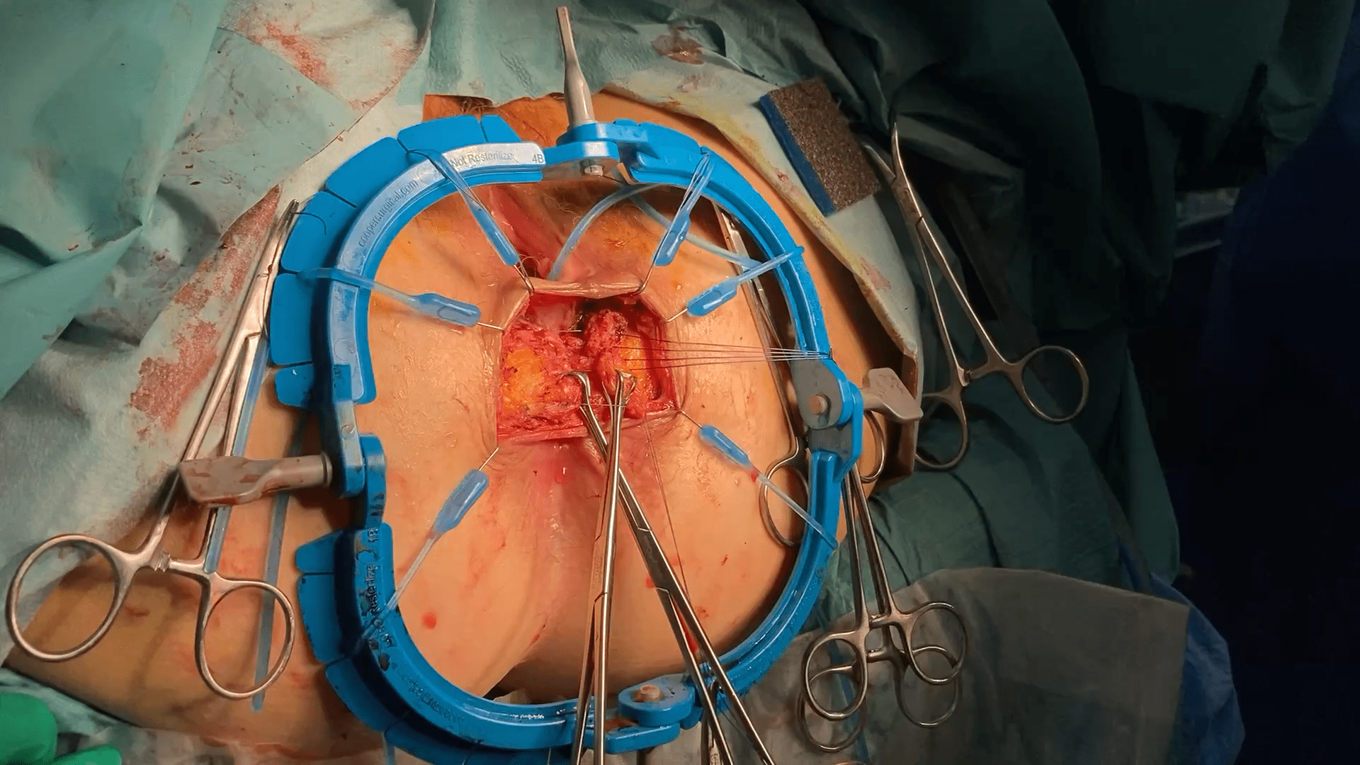 Surgery