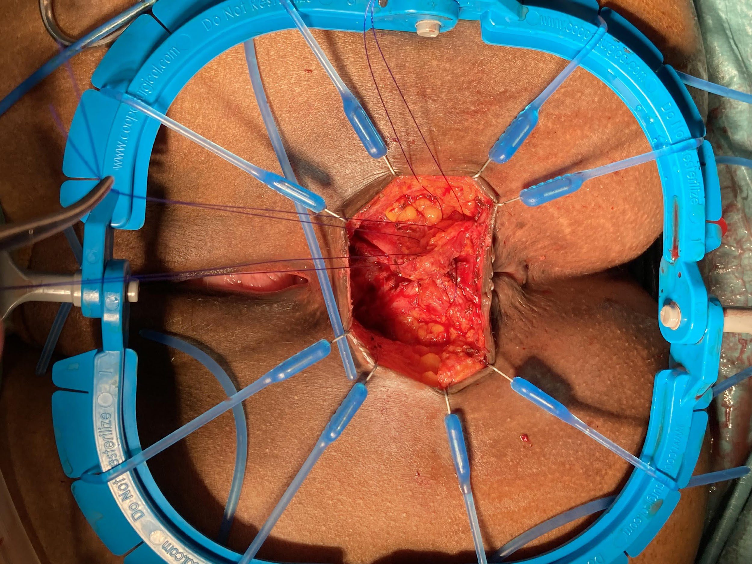 Surgery